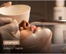 Después del tratamiento de botox en frente