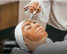 Antes del tratamiento de botox en frente
