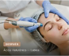 Después del tratamiento de ácido hialurónico en labios