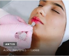 Antes del tratamiento de ácido hialurónico en labios