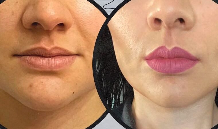 Botox antes y después: qué esperar y caso real