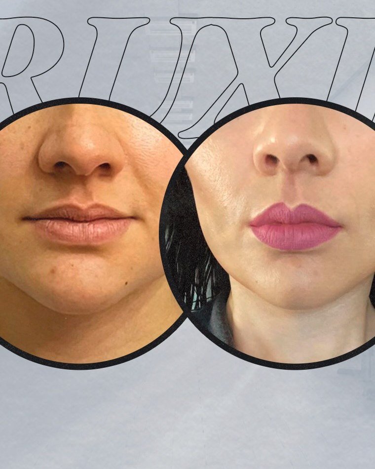 Antes y después de botox en maseteros para bruxismo en Mérida